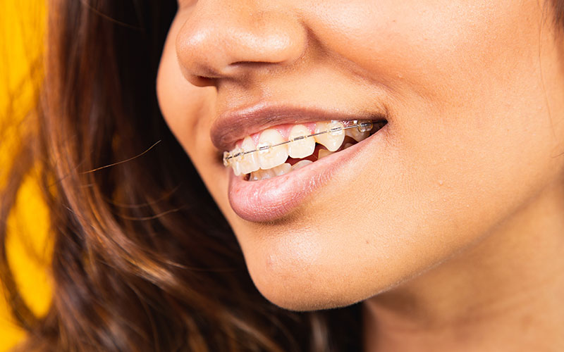 The image features a woman with braces, smiling at the camera.