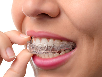 A person with a clear retainer in their mouth, examining it closely.